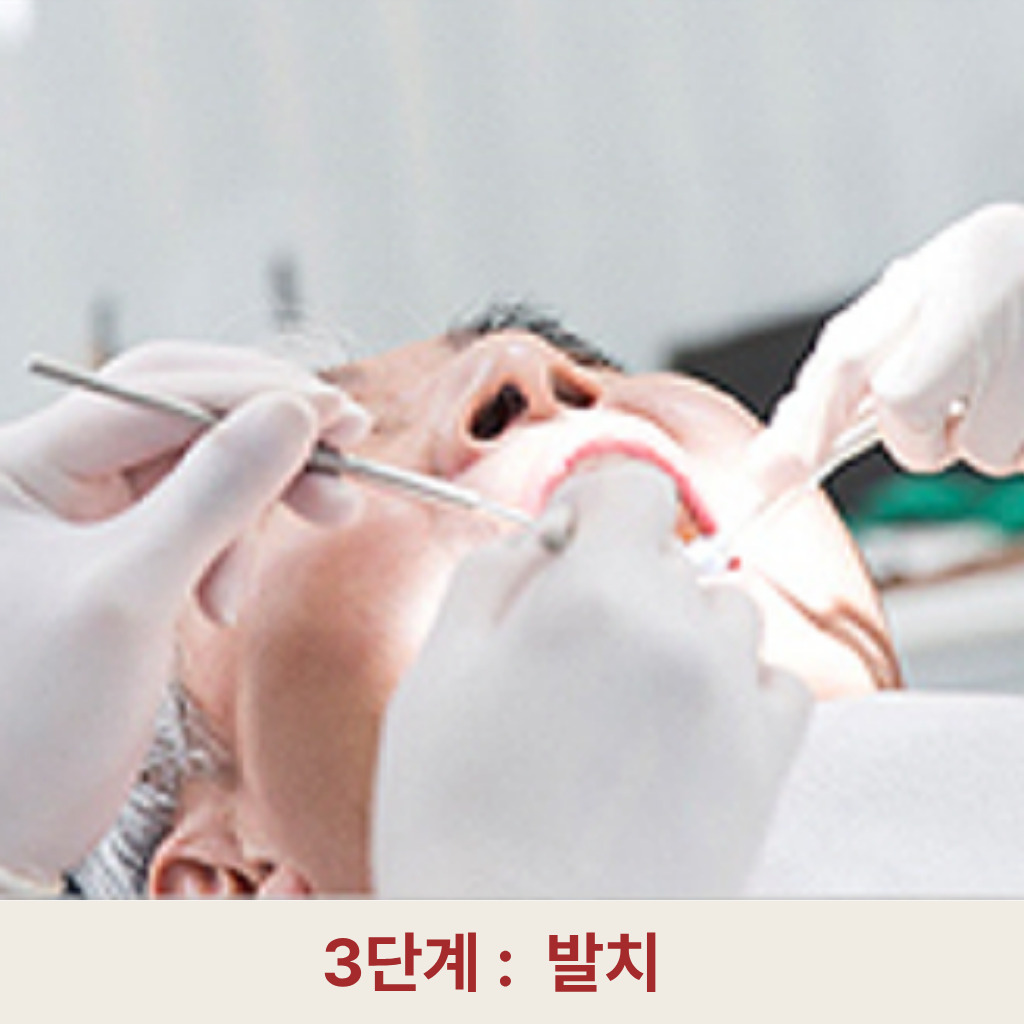3단계: 발치