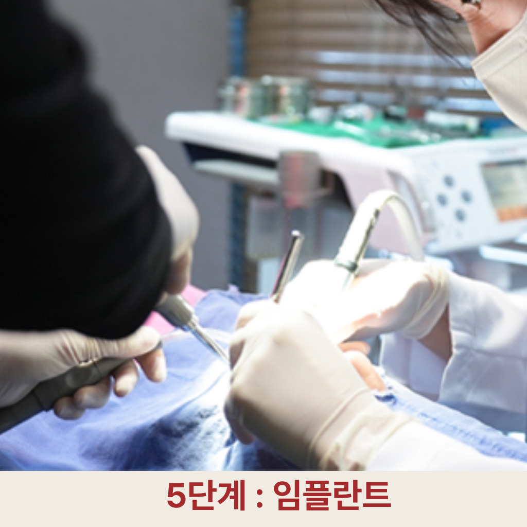 5단계: 임플란트 식립
